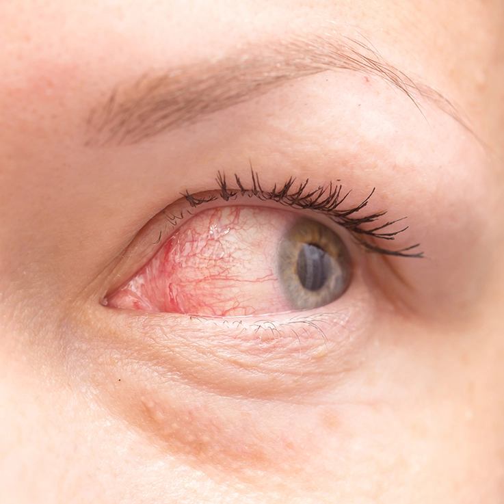 Conjunctivits 3ISS1346815992800 pix 1