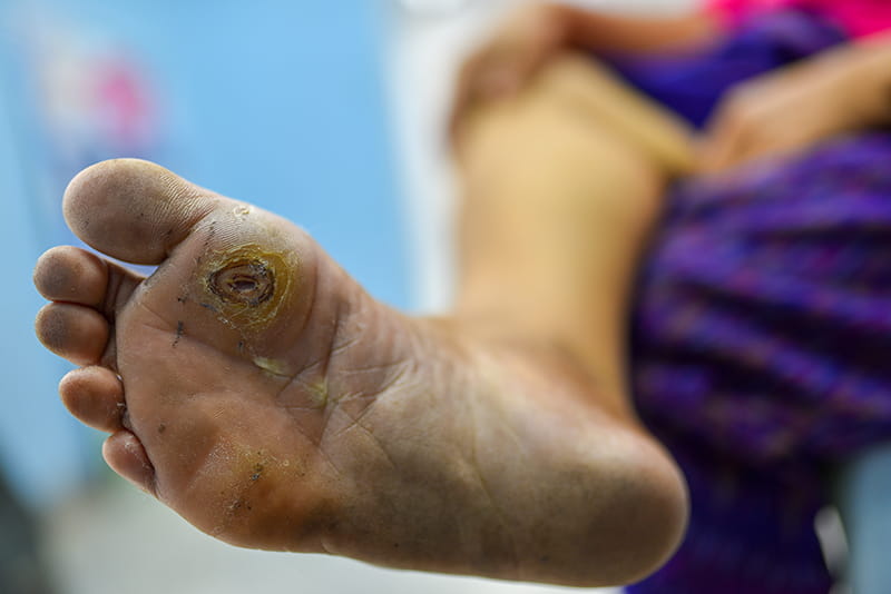 Foot_Ulcer_5