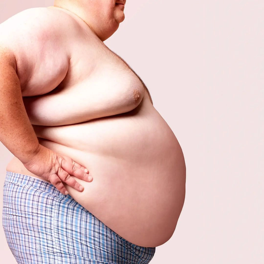 MObesity6